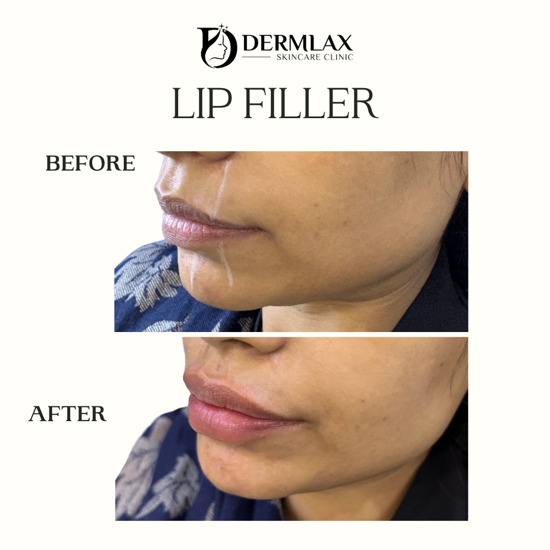 Lip Filler – Before & after before and after at Dermlax Skincare Clinic Karachi