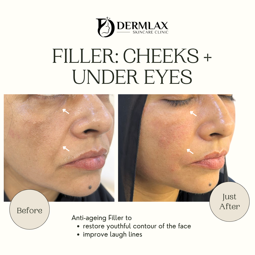 Filler – Cheeks + under eyes before and after at Dermlax Skincare Clinic Karachi