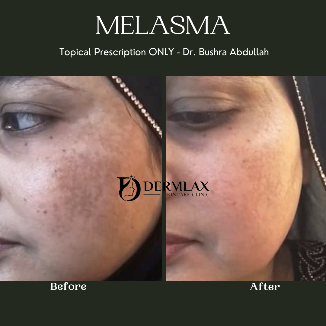 Melasma – Pigmentation reduced before and after at Dermlax Skincare Clinic Karachi