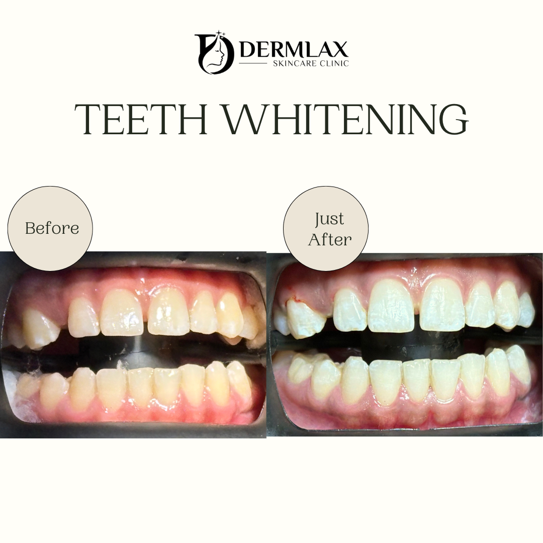 Teeth Whitening – Whiter smile before and after at Dermlax Skincare Clinic Karachi