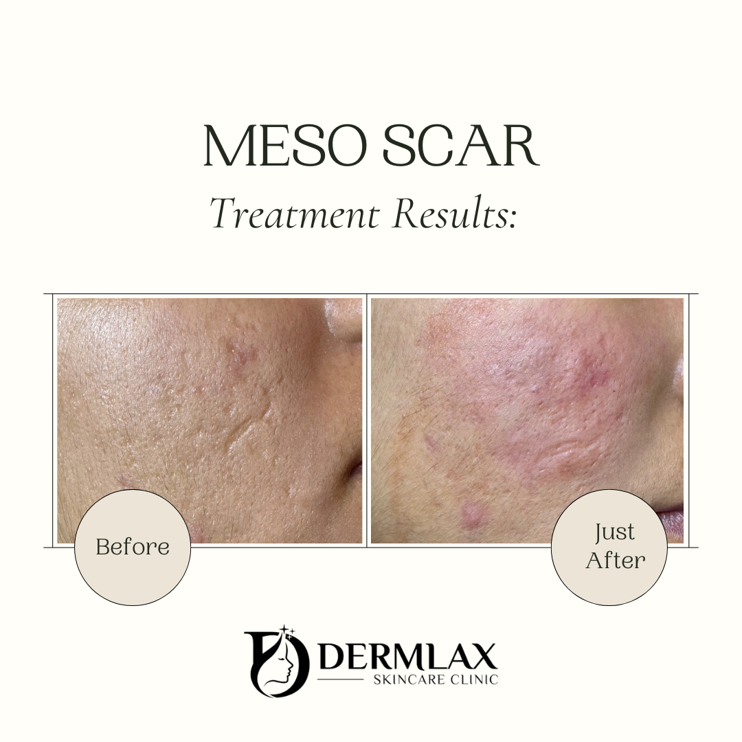 Meso Scar – Acne scar treatment results before and after at Dermlax Skincare Clinic Karachi