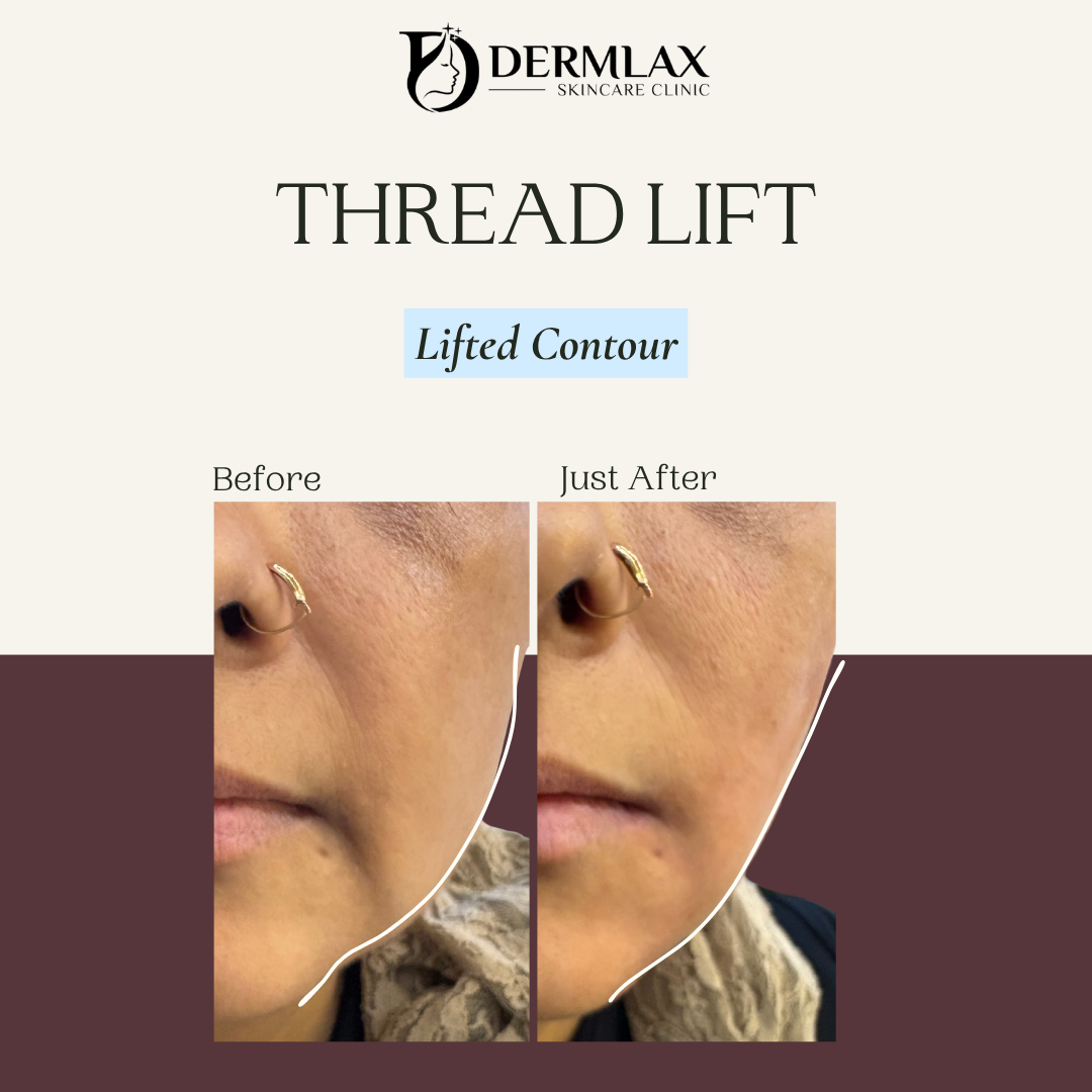Thread Lift – Lifted contour before and after at Dermlax Skincare Clinic Karachi