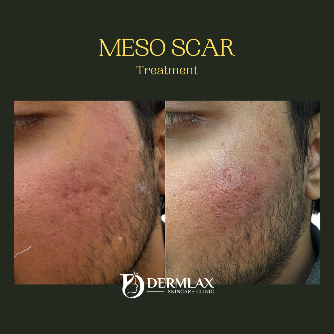 Meso Scar – Acne scar treatment before and after at Dermlax Skincare Clinic Karachi