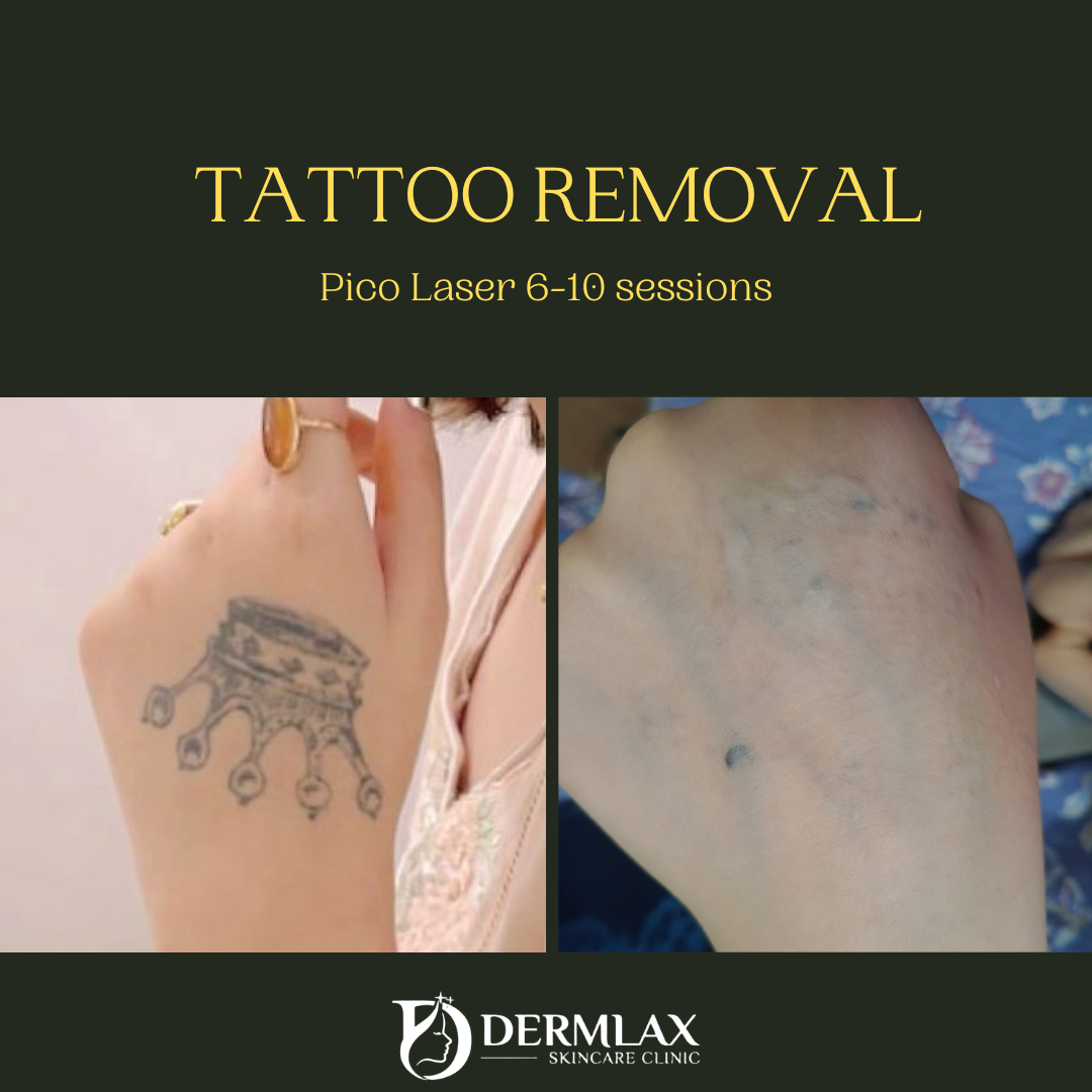 Tattoo Removal – Pico laser, 6–10 sessions before and after at Dermlax Skincare Clinic Karachi
