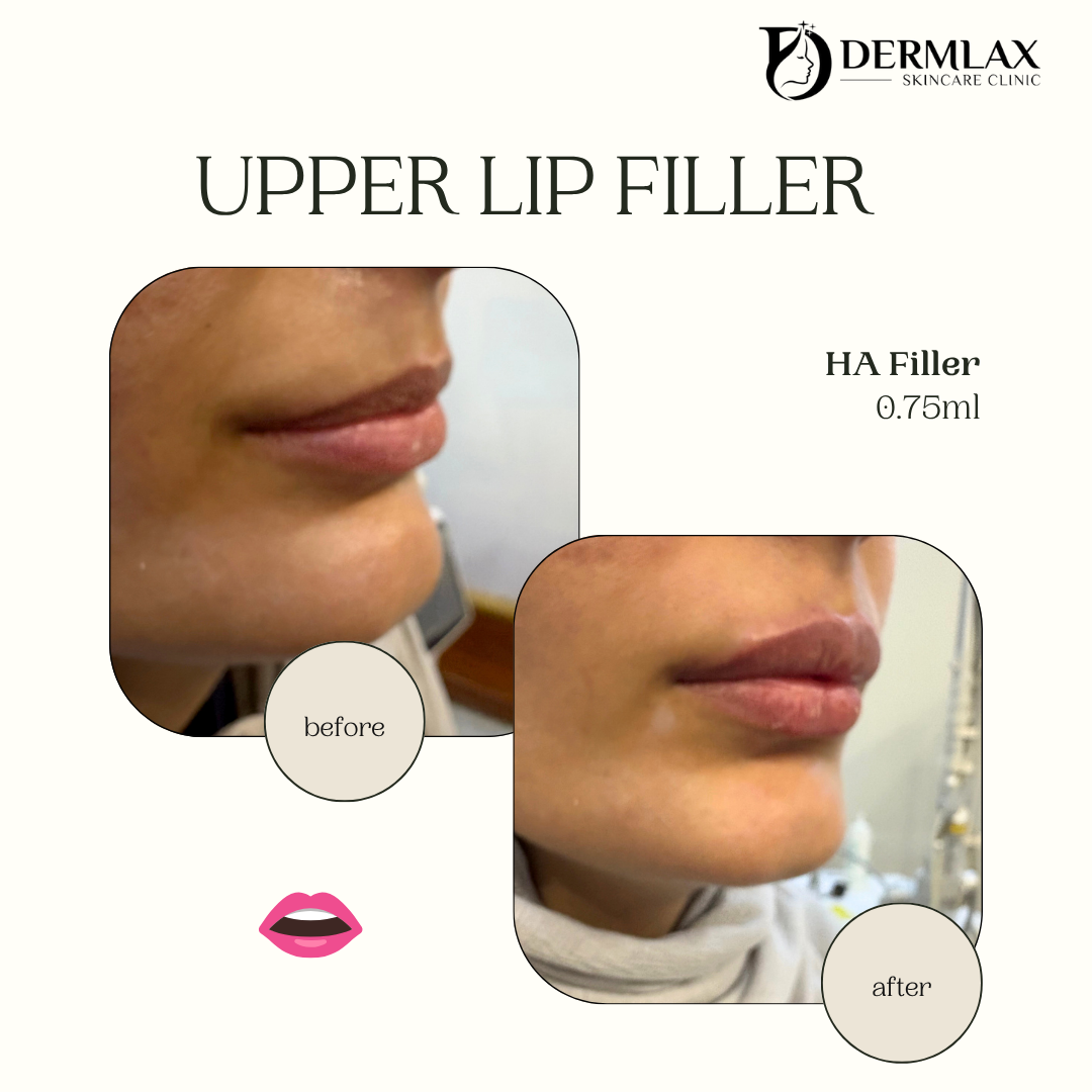 Upper Lip Filler – HA filler 0.75ml before and after at Dermlax Skincare Clinic Karachi