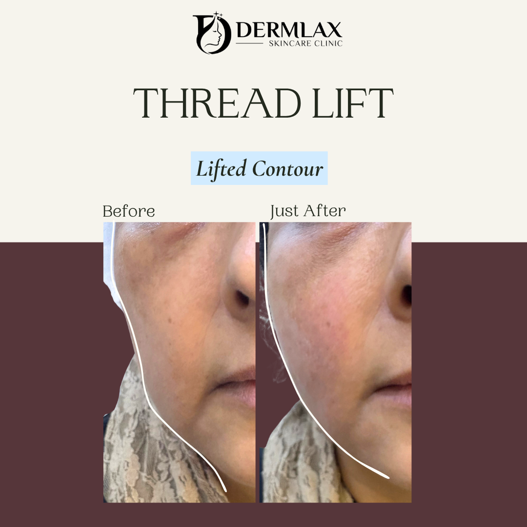 Thread Lift – Lifted contour before and after at Dermlax Skincare Clinic Karachi