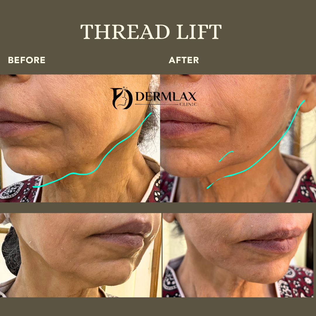 Thread Lift – Jawline & jowls lifted before and after at Dermlax Skincare Clinic Karachi