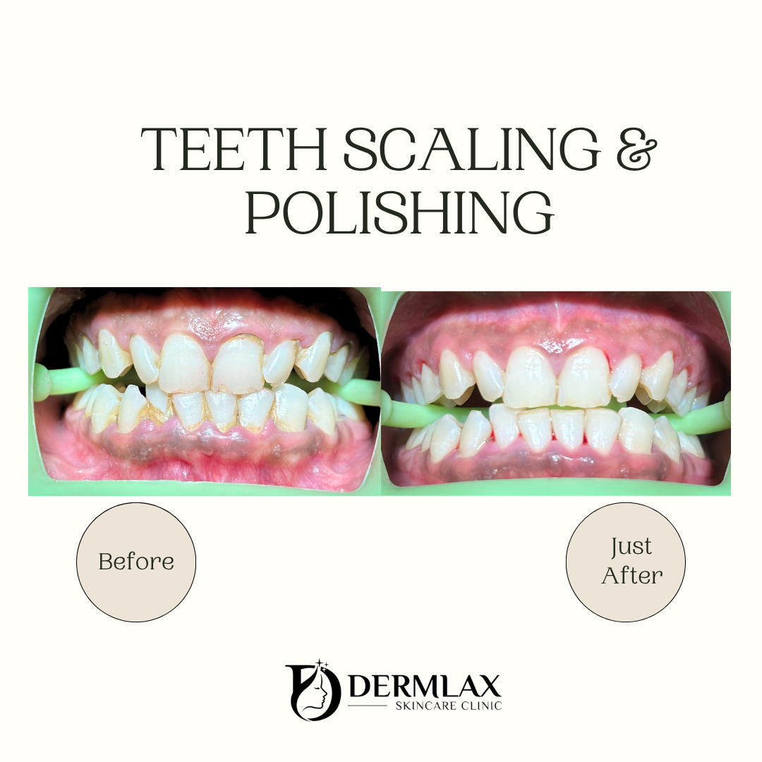 Teeth Scaling & Polishing – Cleaner, brighter teeth before and after at Dermlax Skincare Clinic Karachi