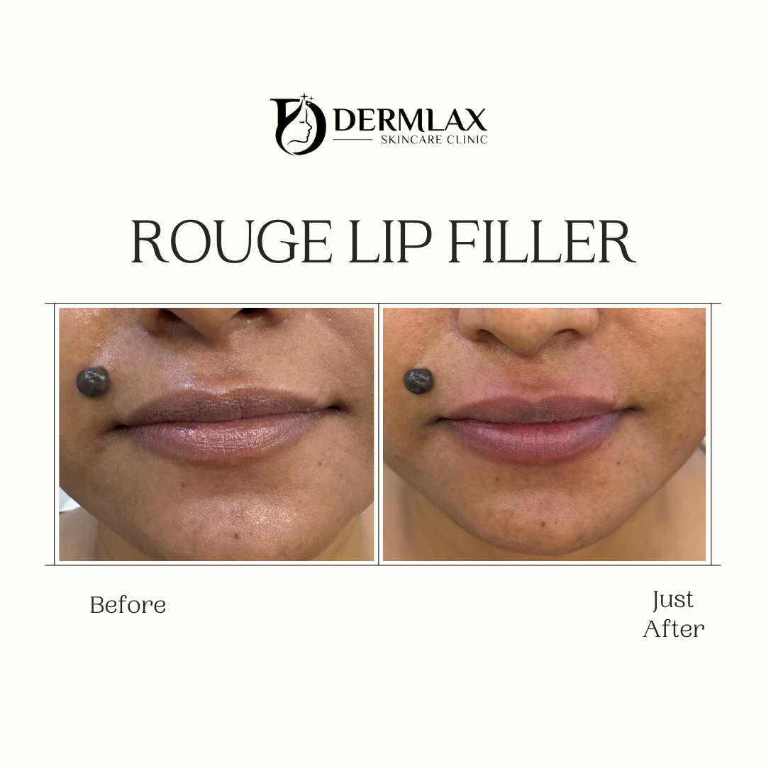 Rouge Lip Filler – Natural lip volume before and after at Dermlax Skincare Clinic Karachi