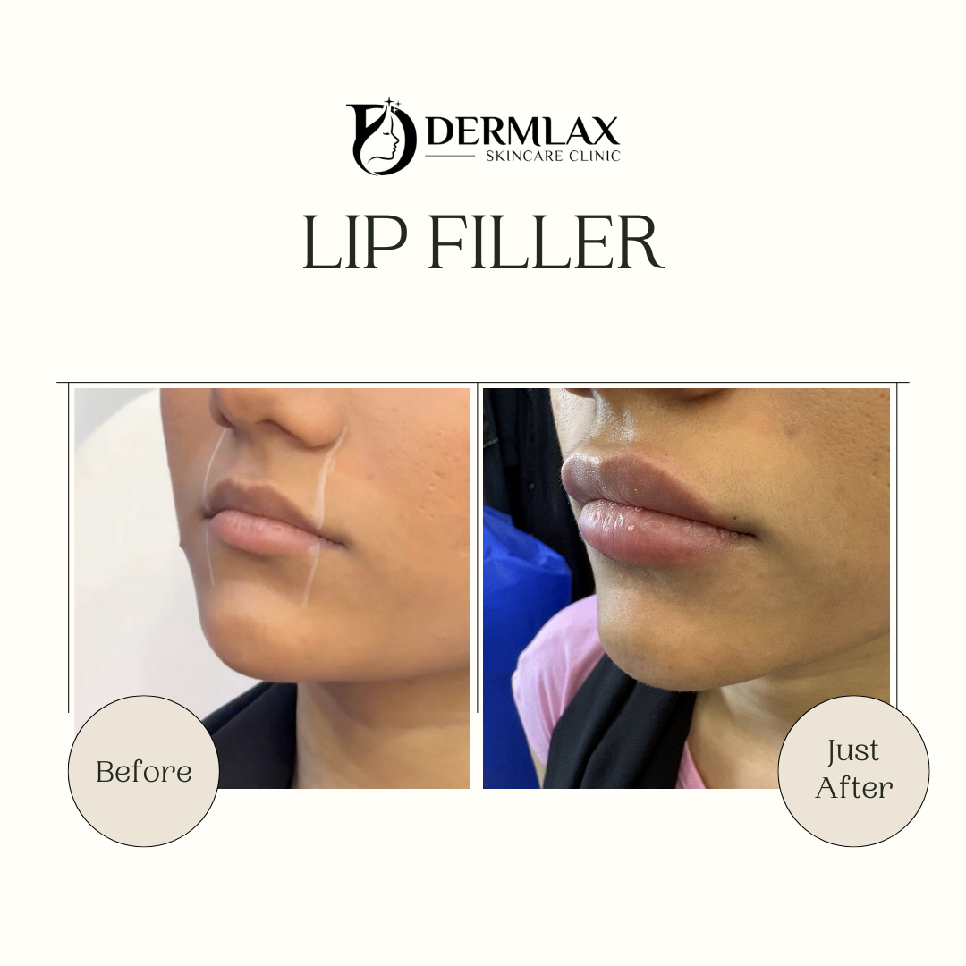 Lip Filler – Fuller, defined lips before and after at Dermlax Skincare Clinic Karachi