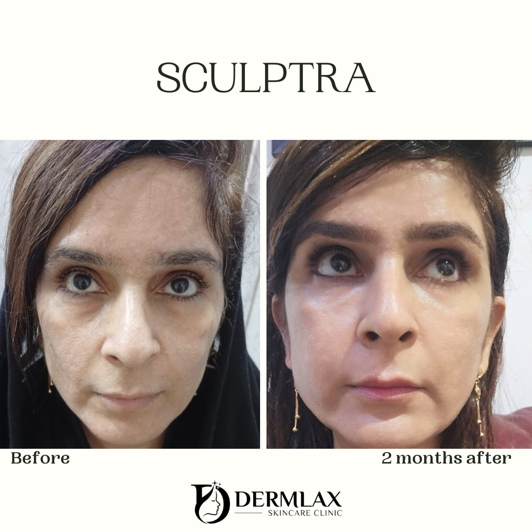 Sculptra – Collagen stimulation & facial volume before and after at Dermlax Skincare Clinic Karachi